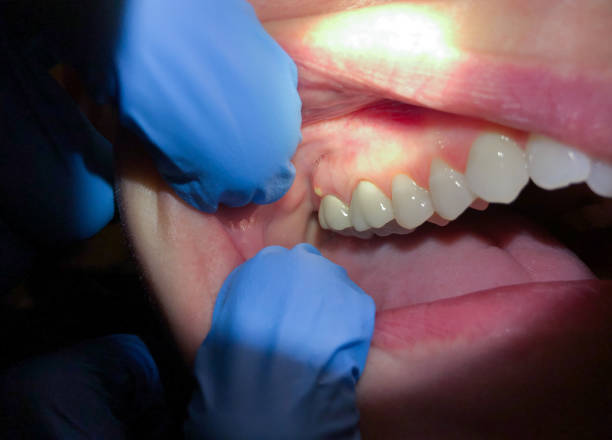 Best Emergency Dentist for Knocked-Out Tooth in Hawkinsville, GA